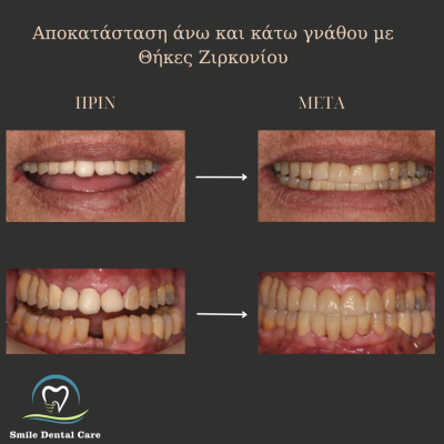Παρατηρείτε αιμορραγία των ούλων κατά τη διάρκεια του βουρτσίσματος? - 9