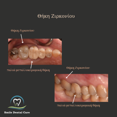 Παρατηρείτε αιμορραγία των ούλων κατά τη διάρκεια του βουρτσίσματος? - 12